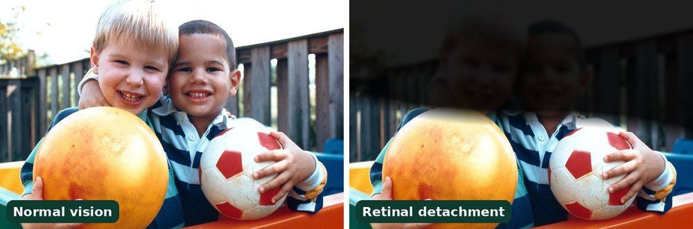 Simulation of retinal detachment (retina ka khisakna): a dark shadow like a curtain covers the upper part of the view on the right, compared with normal vision on the left